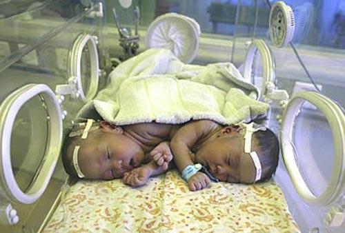 Тревога за сердца для сиамских близнецов