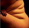 Тяжелая форма ожирения сокращает продолжительность жизни на 10 лет