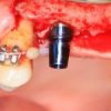 «Созданы антибактериальные зубные имплантаты »