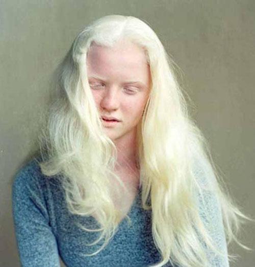Окулокутанный альбинизм 